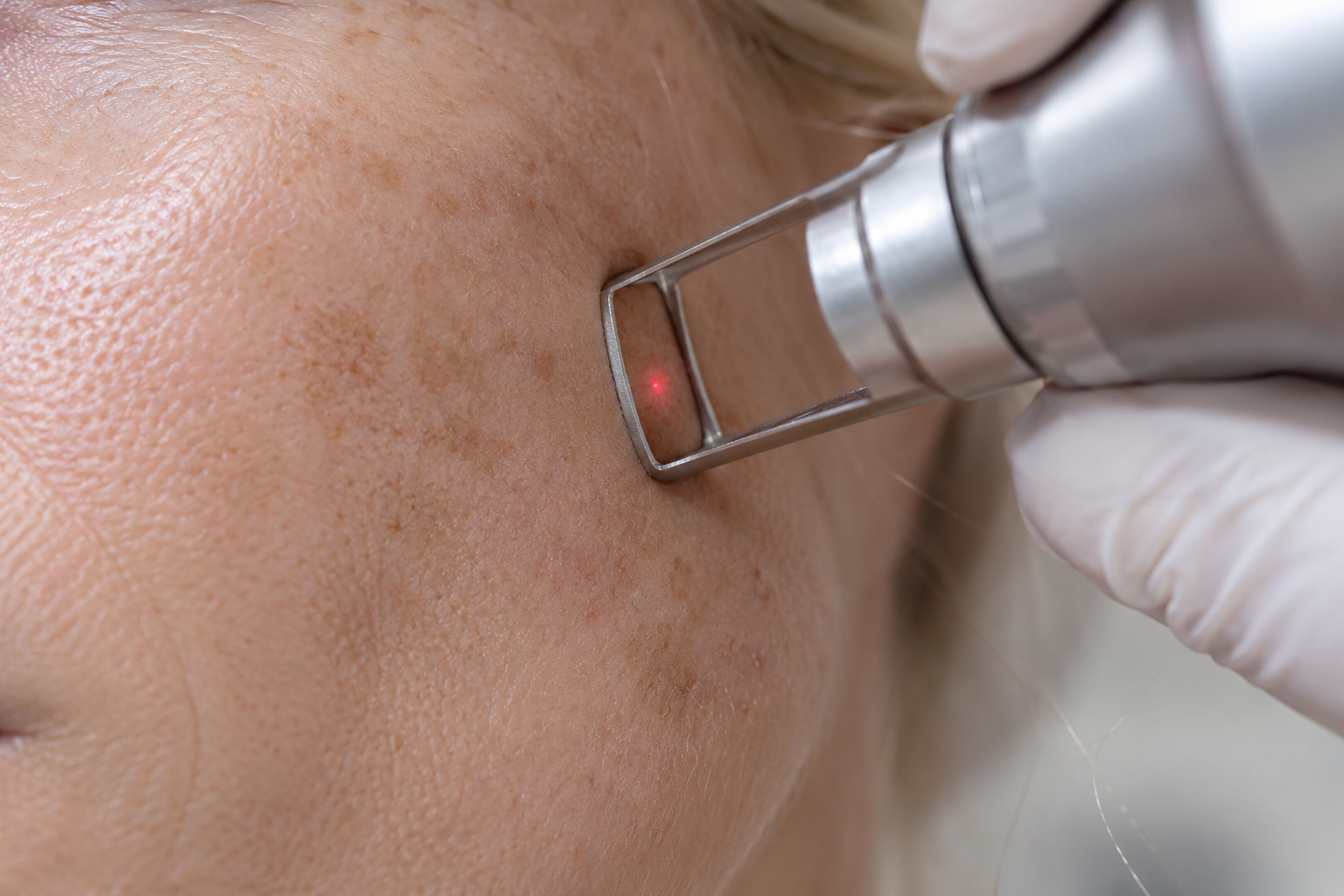 Pico laser over uneven cheek tone